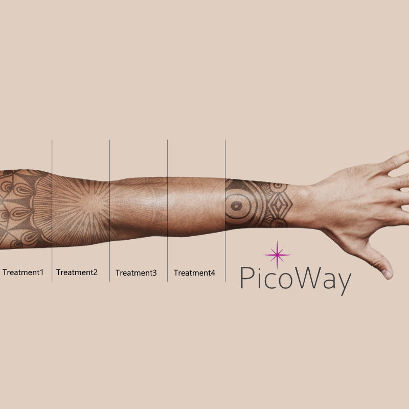 Tattoo Removal: Understanding The PicoWay Laser - Blush Beverly Hills