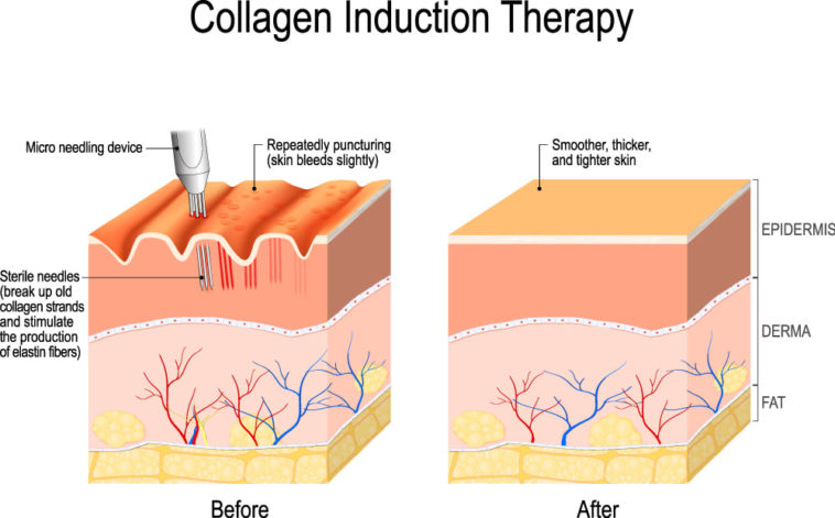 Skin Needling page