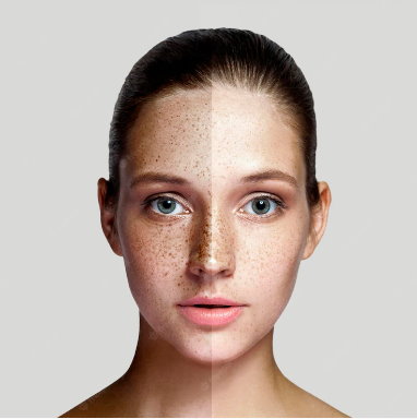 Melasma Laser Removal